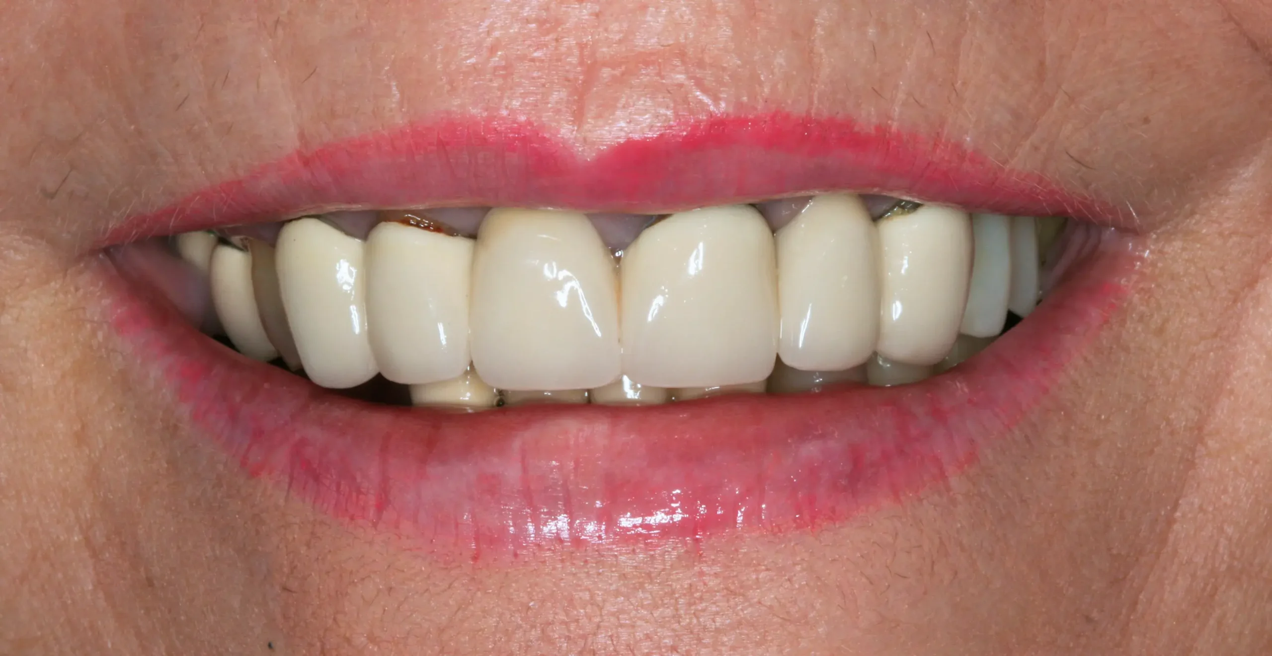 Antes — Rehabilitación completa: implantes y coronas de zirconio