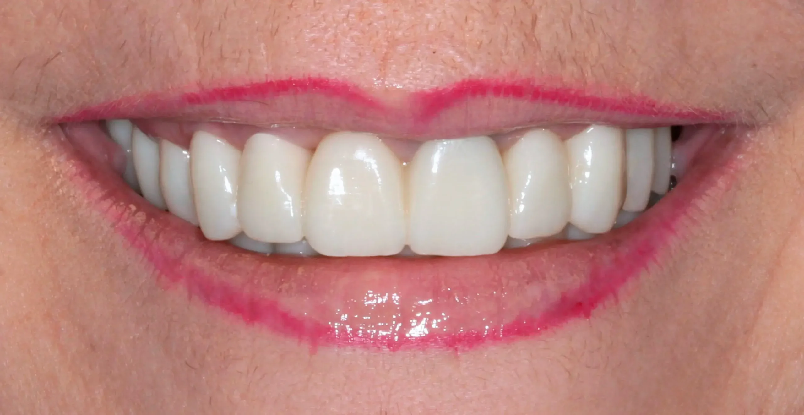 Después — Rehabilitación completa: implantes y coronas de zirconio