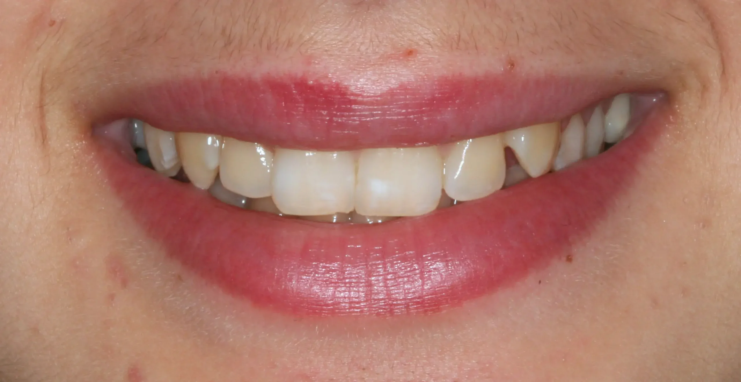 Antes — Ortodoncia con brackets: molar incluido en paladar recolocado