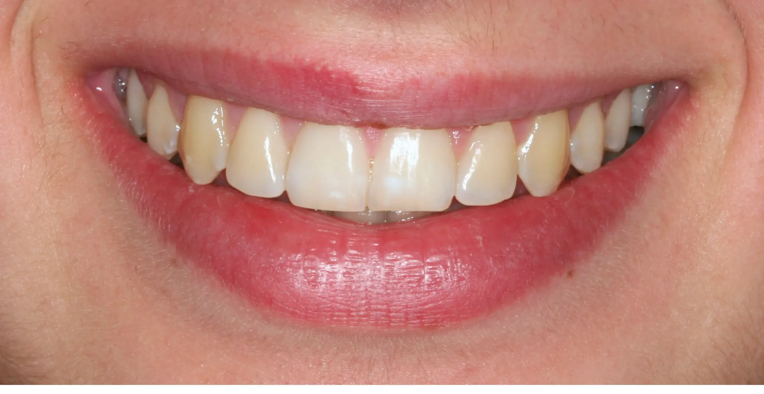 Después — Ortodoncia con brackets: molar incluido en paladar recolocado