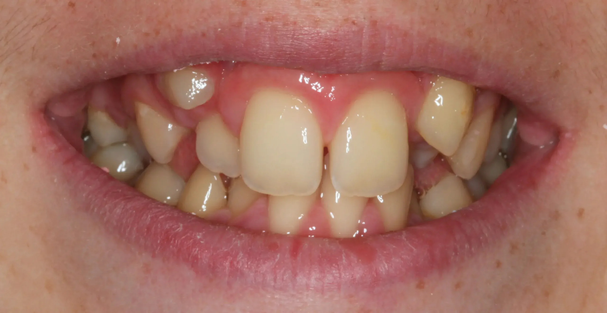 Antes — Ortodoncia con brackets: apiñamiento severo y dientes retenidos