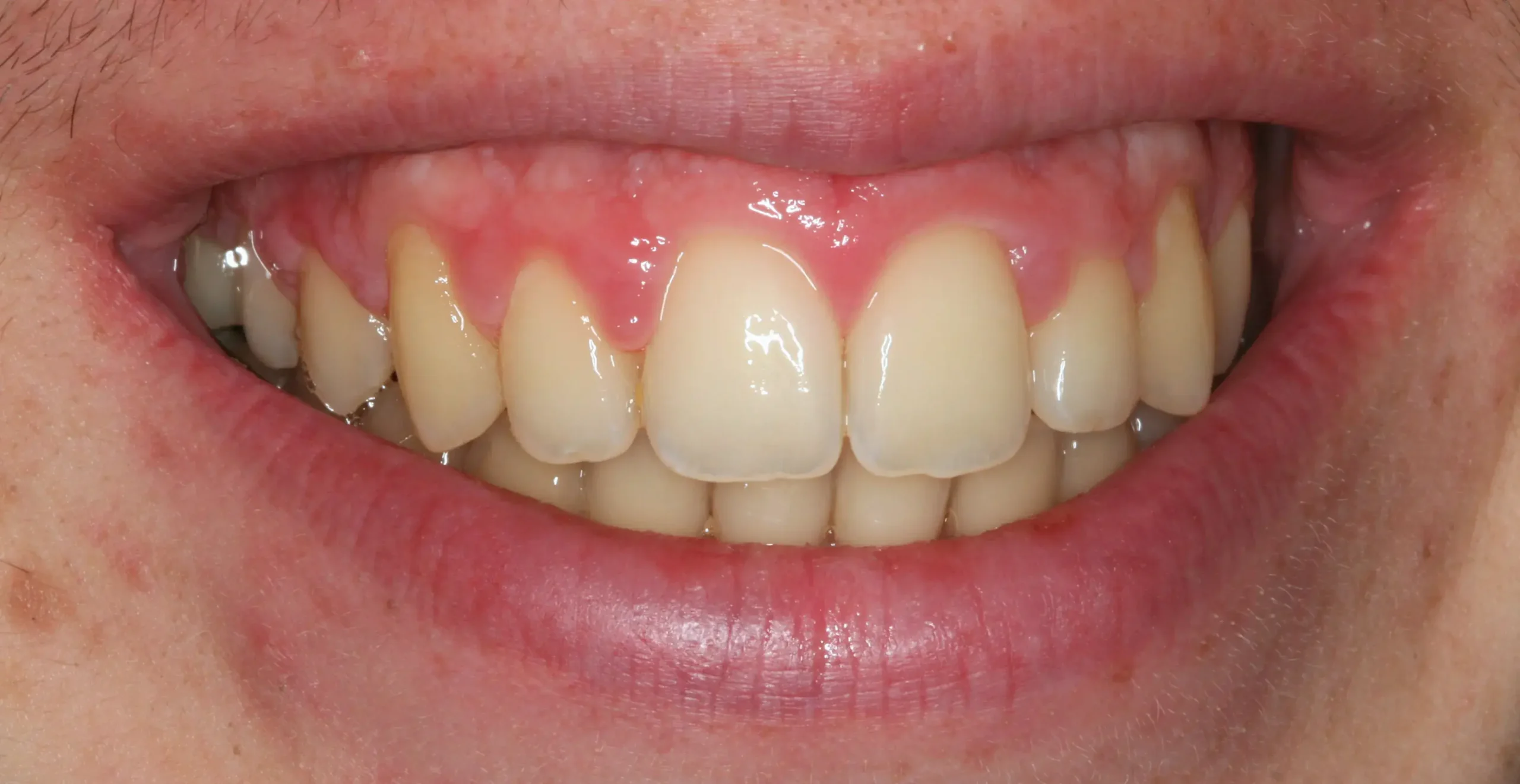 Después — Ortodoncia con brackets: apiñamiento severo y dientes retenidos
