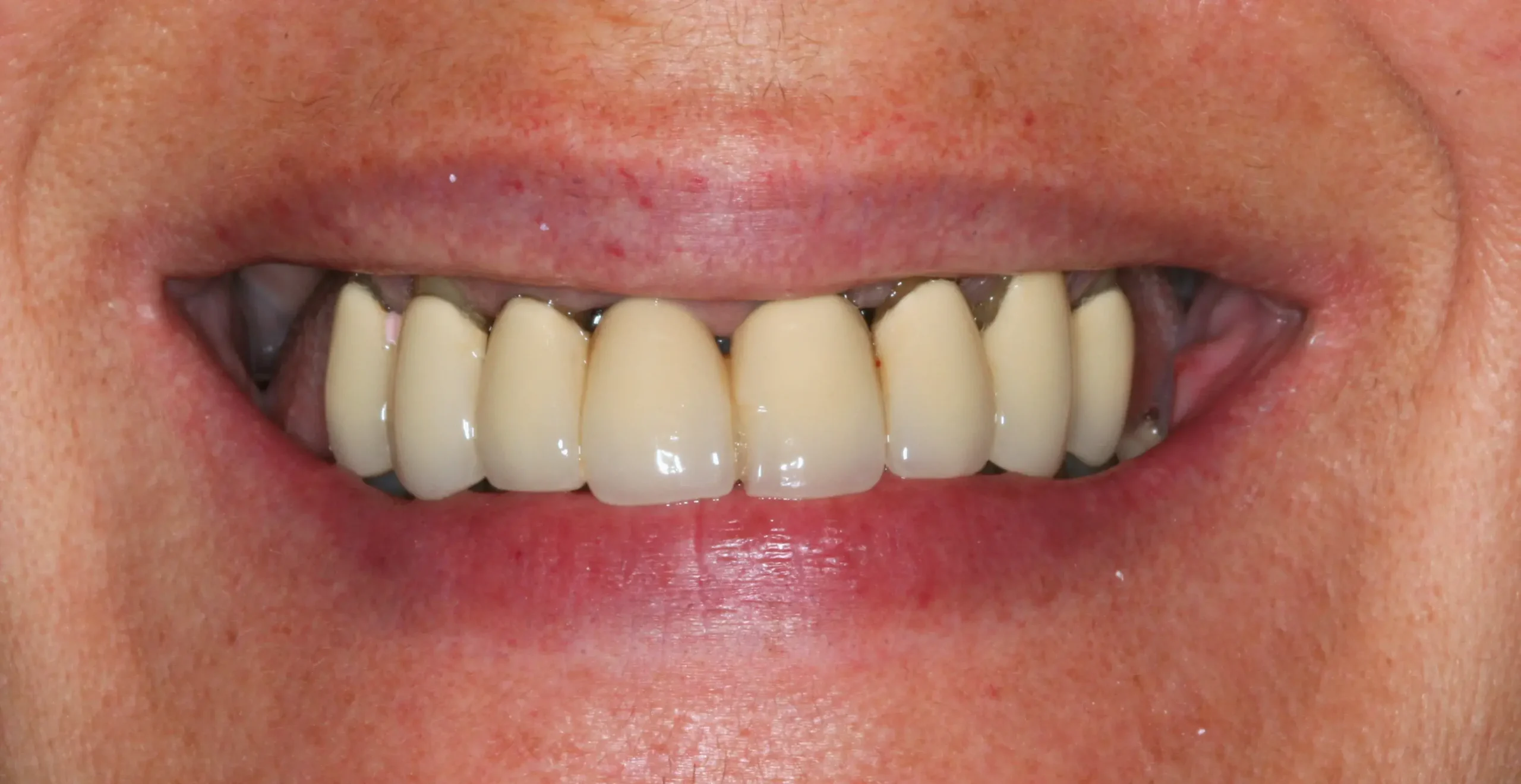 Antes — Rehabilitación oral completa con 10 implantes y zirconio estratificado