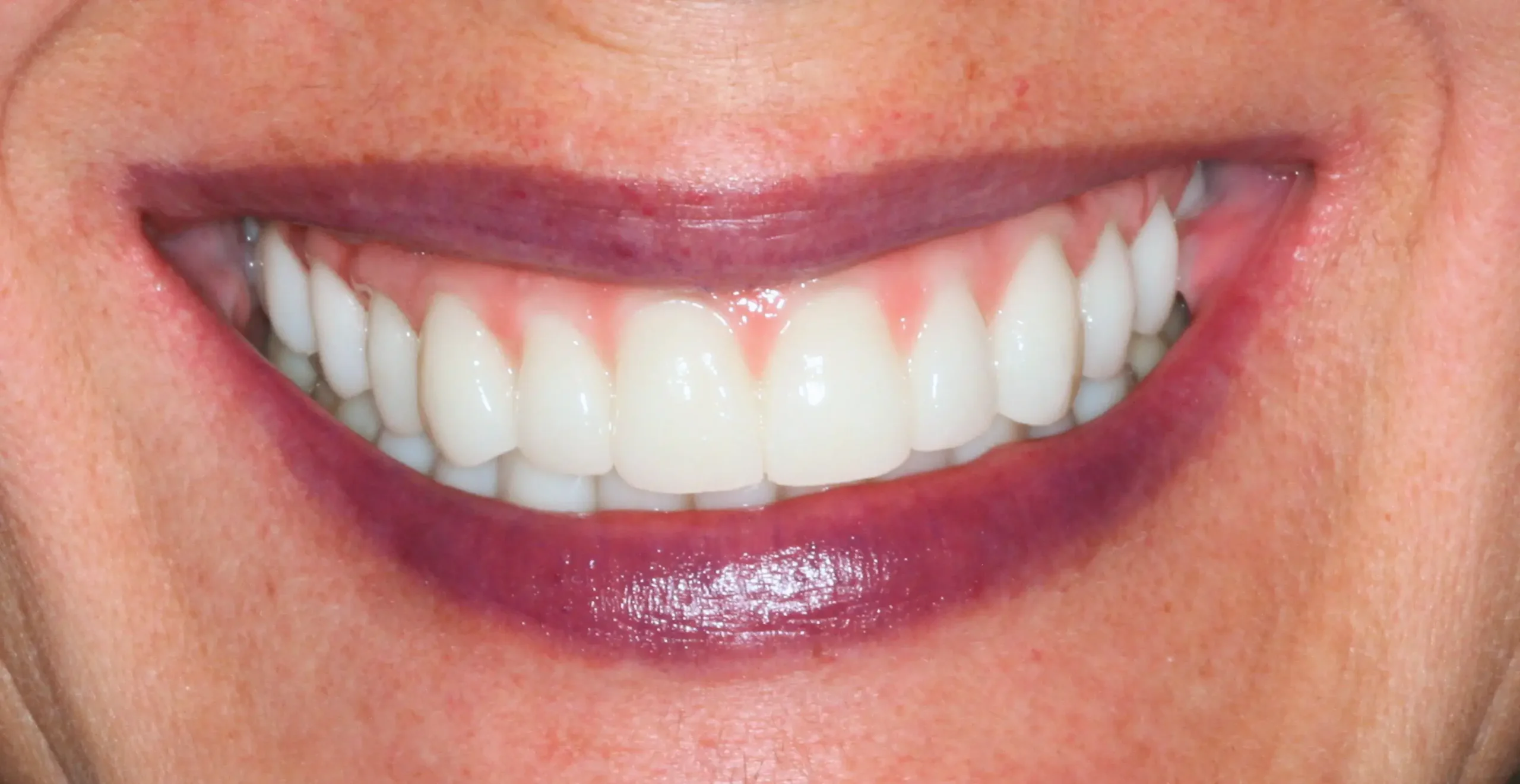 Después — Rehabilitación oral completa con 10 implantes y zirconio estratificado