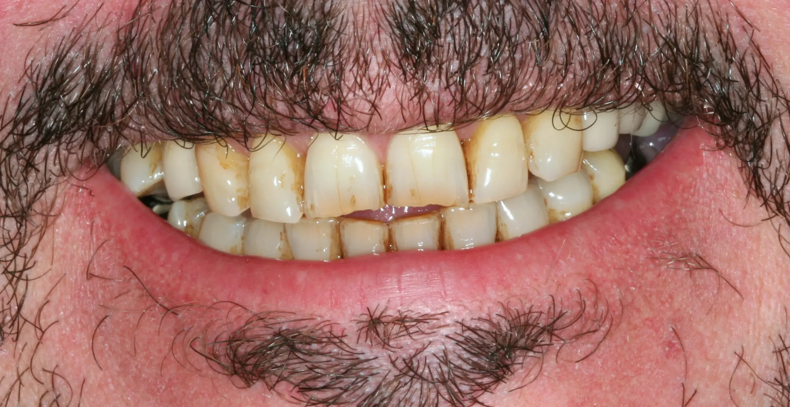 Antes — Implantes y coronas CAD-CAM: rehabilitación funcional y estética
