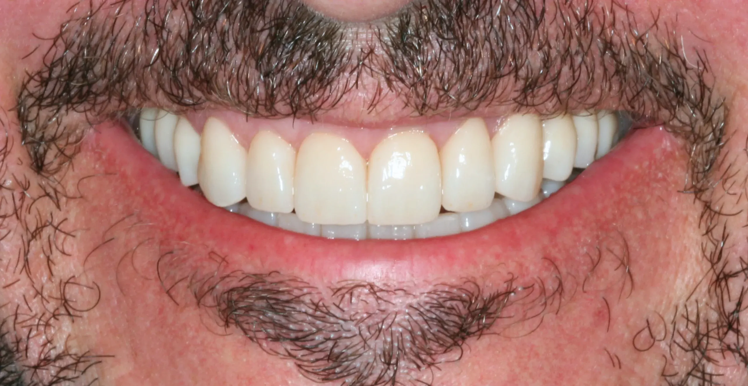 Después — Implantes y coronas CAD-CAM: rehabilitación funcional y estética