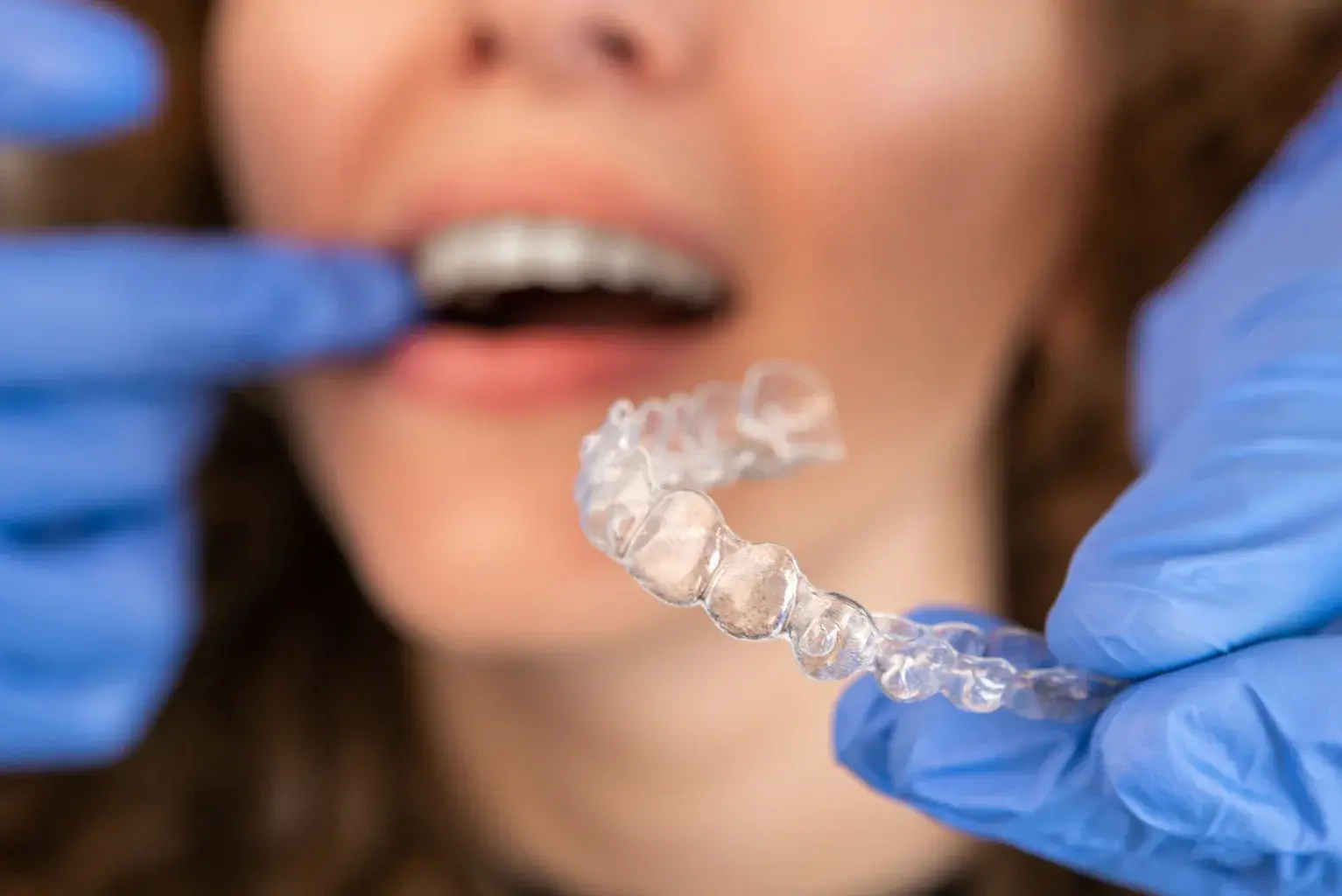 Planificación de tratamiento con alineadores transparentes