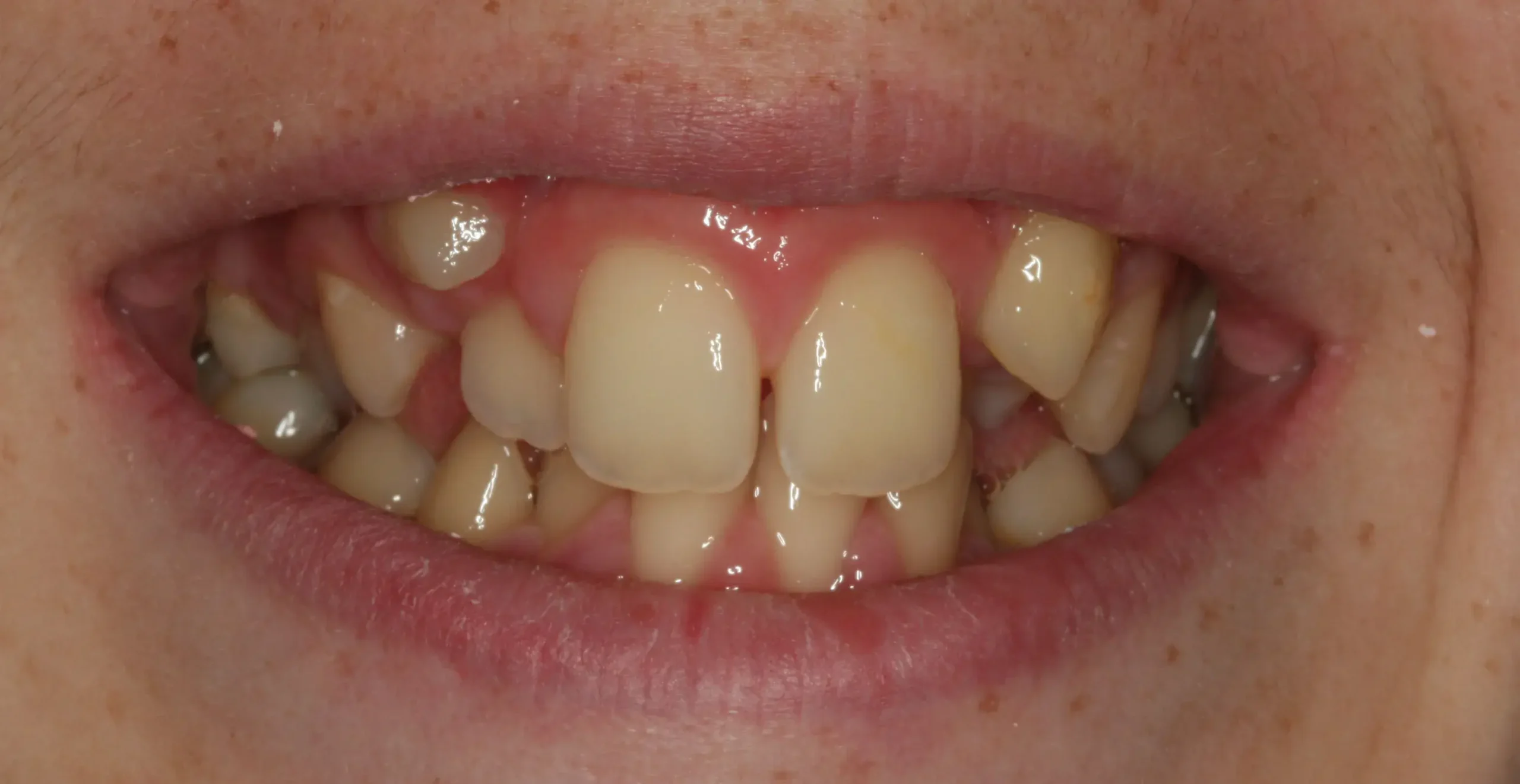 Antes — Ortodoncia con brackets: apiñamiento severo y dientes retenidos