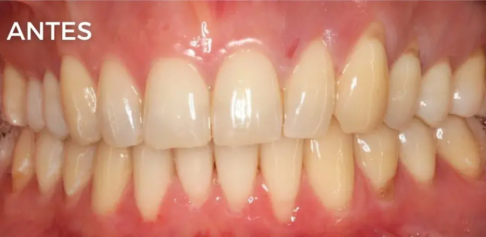Antes — Injerto gingival: recuperación de tejido y salud periodontal