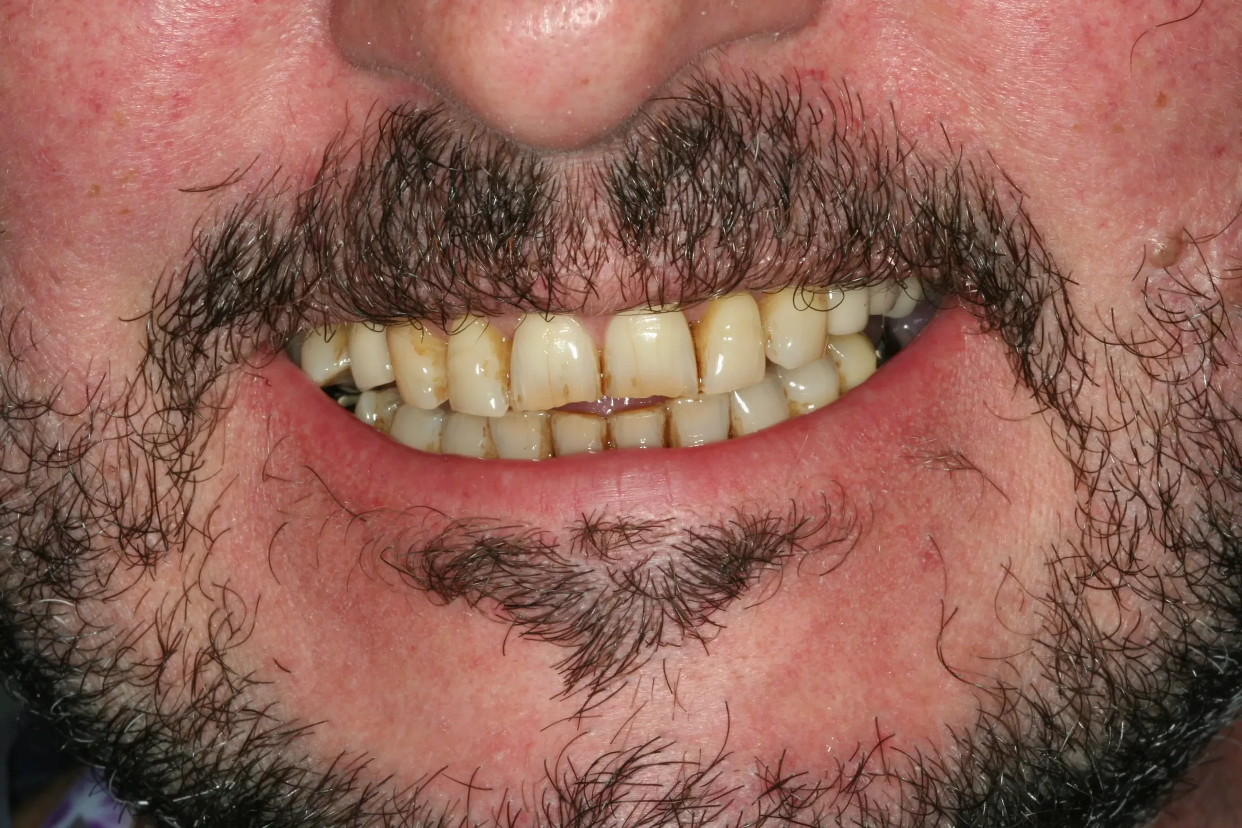 Antes — Implantes y coronas CAD-CAM: rehabilitación funcional y estética