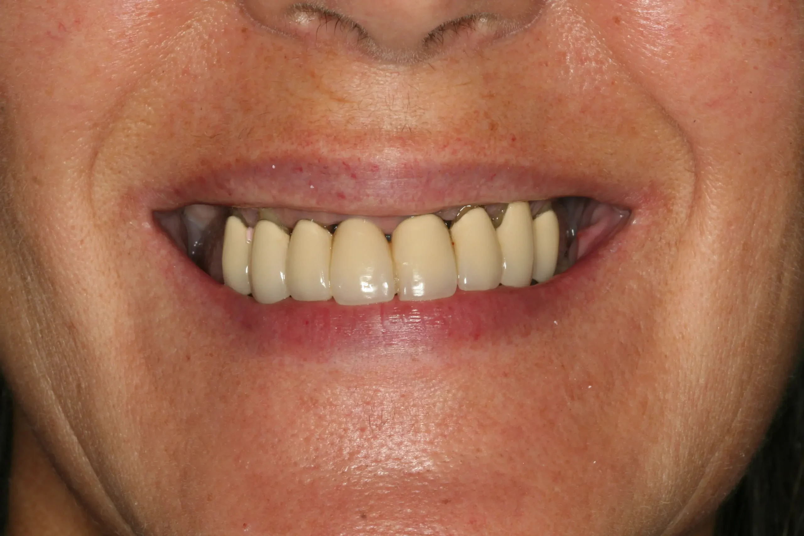 Antes — Rehabilitación oral completa con 10 implantes y zirconio estratificado