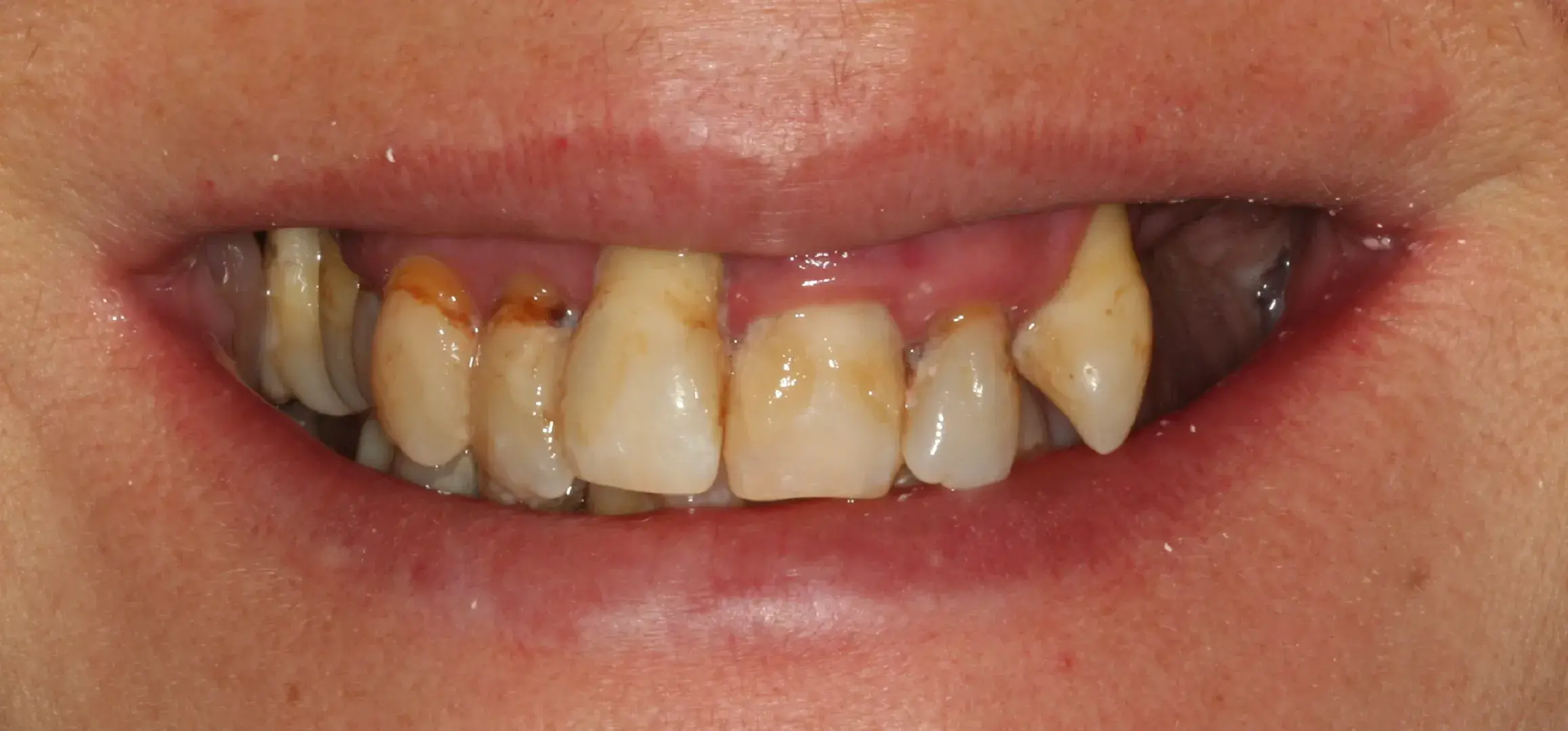 Antes — Rehabilitación completa tras enfermedad periodontal avanzada