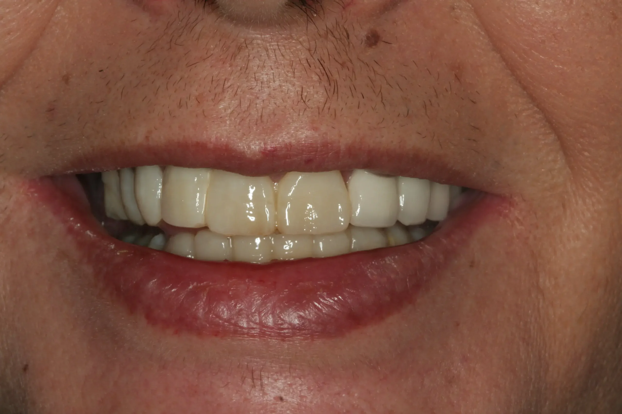 Antes — Rehabilitación completa: implantes y coronas de zirconio