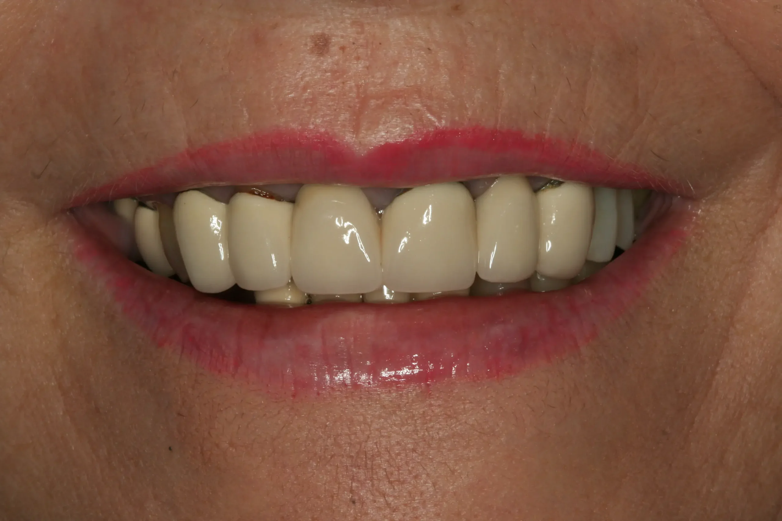 Antes — Coronas de zirconio estratificado con resultado natural