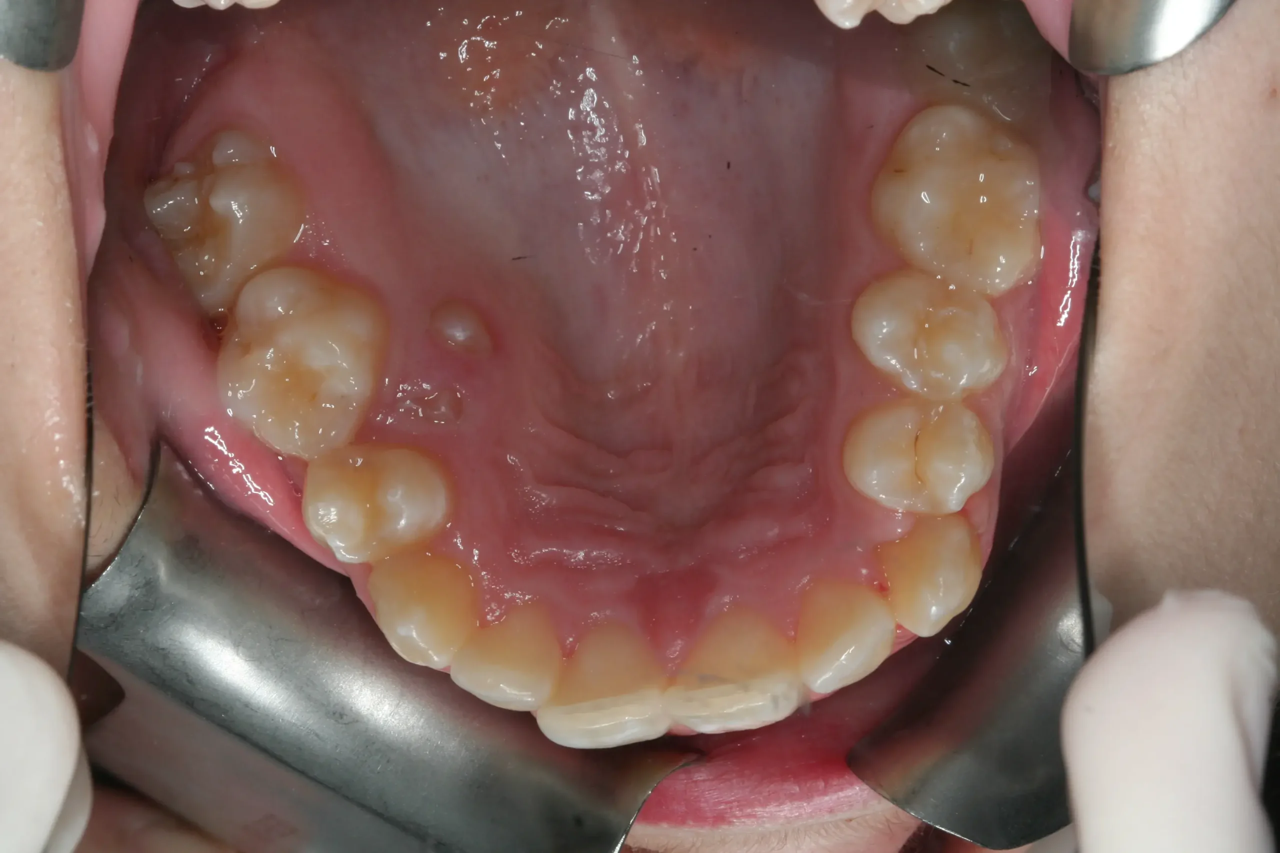 Molar incluido en paladar recolocado