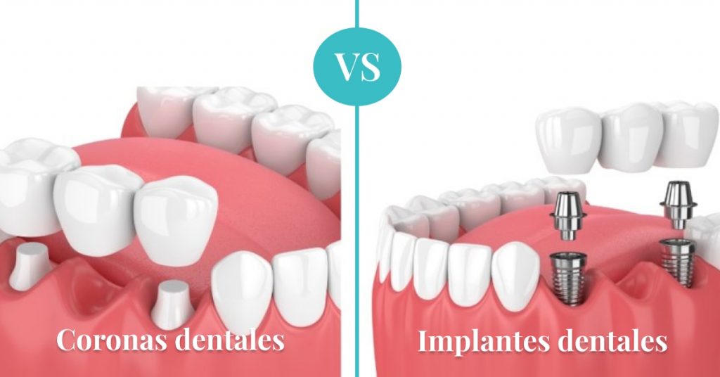 Tratamiento con Coronas Dentales vs Implantes Dentales