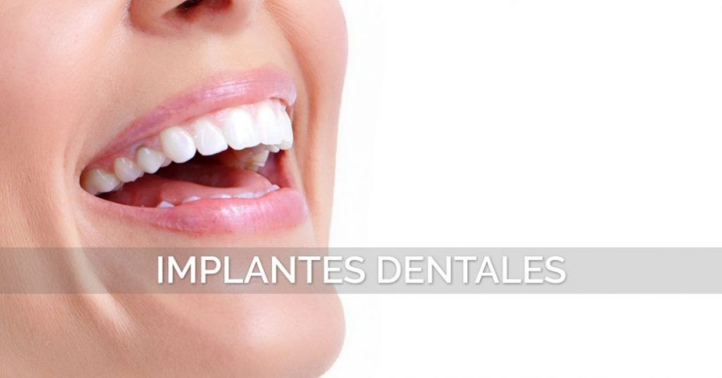 ¿Qué debes saber sobre los implantes dentales?