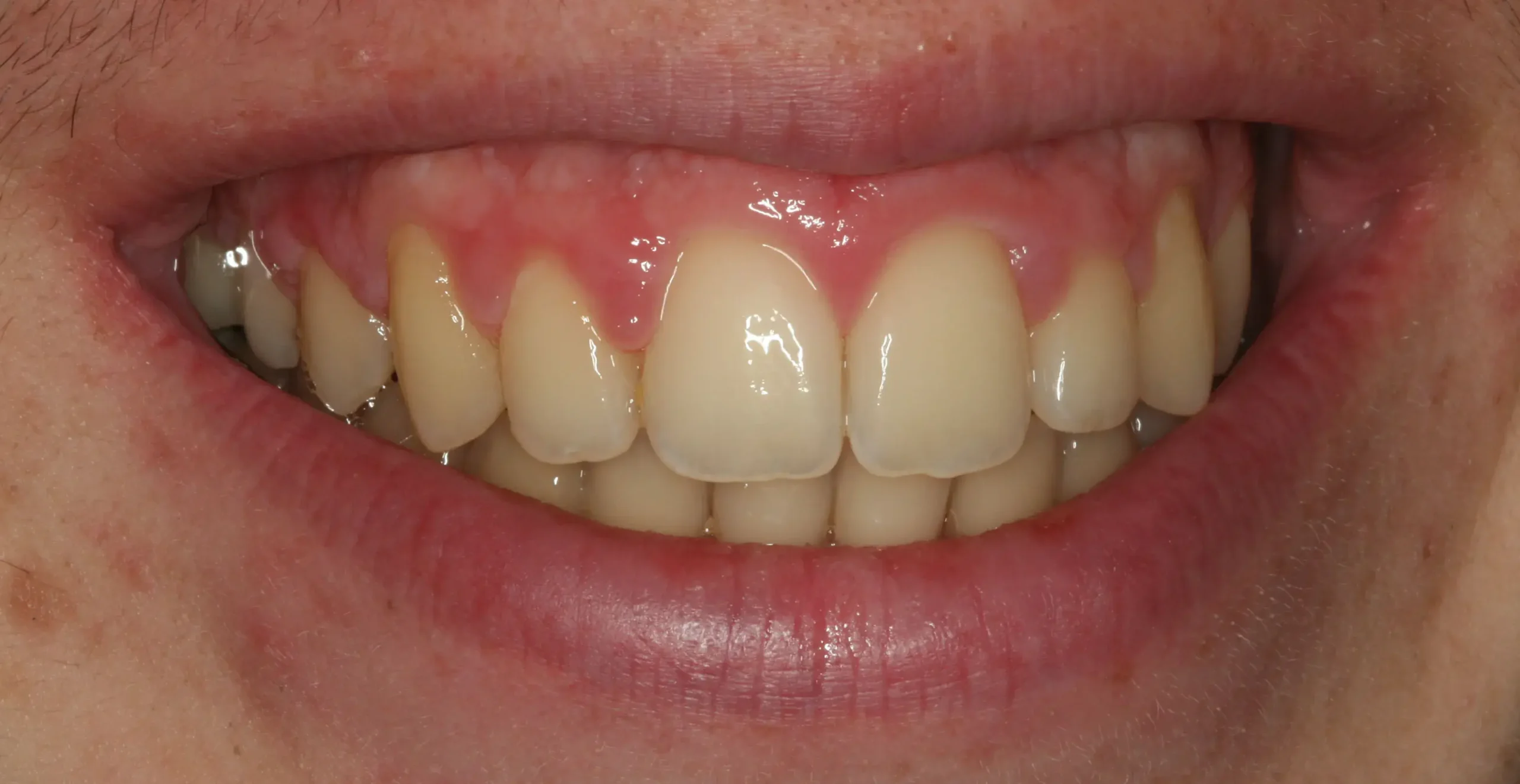 Después — Ortodoncia con brackets: apiñamiento severo y dientes retenidos