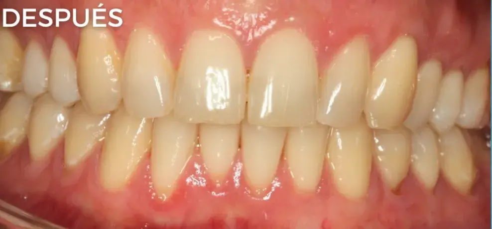 Después — Injerto gingival: recuperación de tejido y salud periodontal