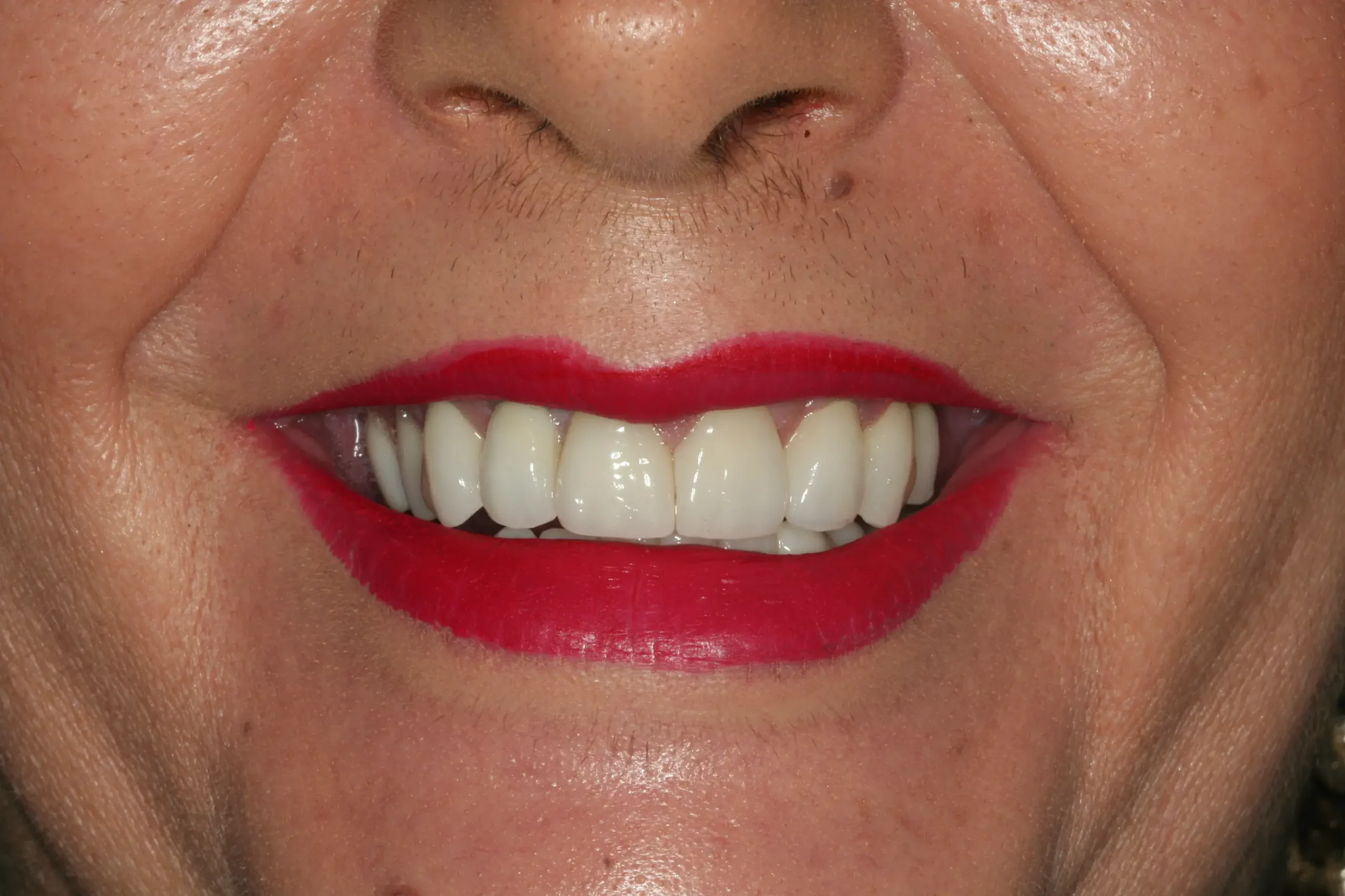 Después — Rehabilitación completa: implantes y coronas de zirconio