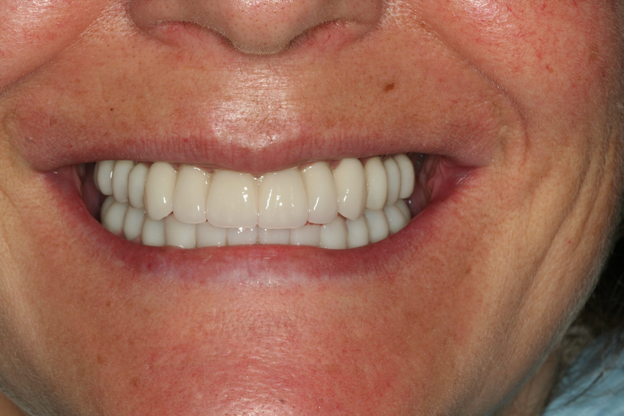 Después — Rehabilitación completa tras enfermedad periodontal avanzada