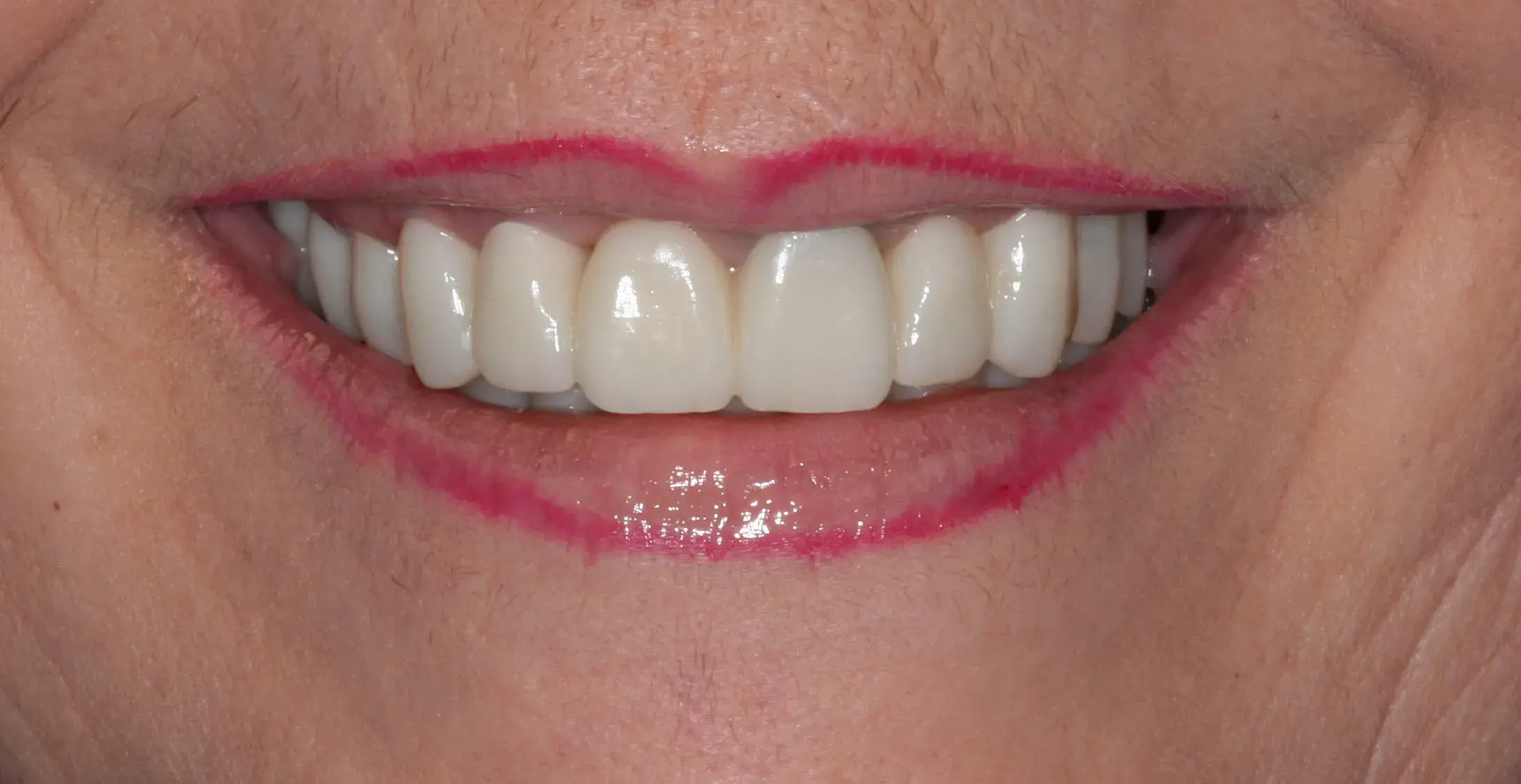 Después — Coronas de zirconio estratificado con resultado natural