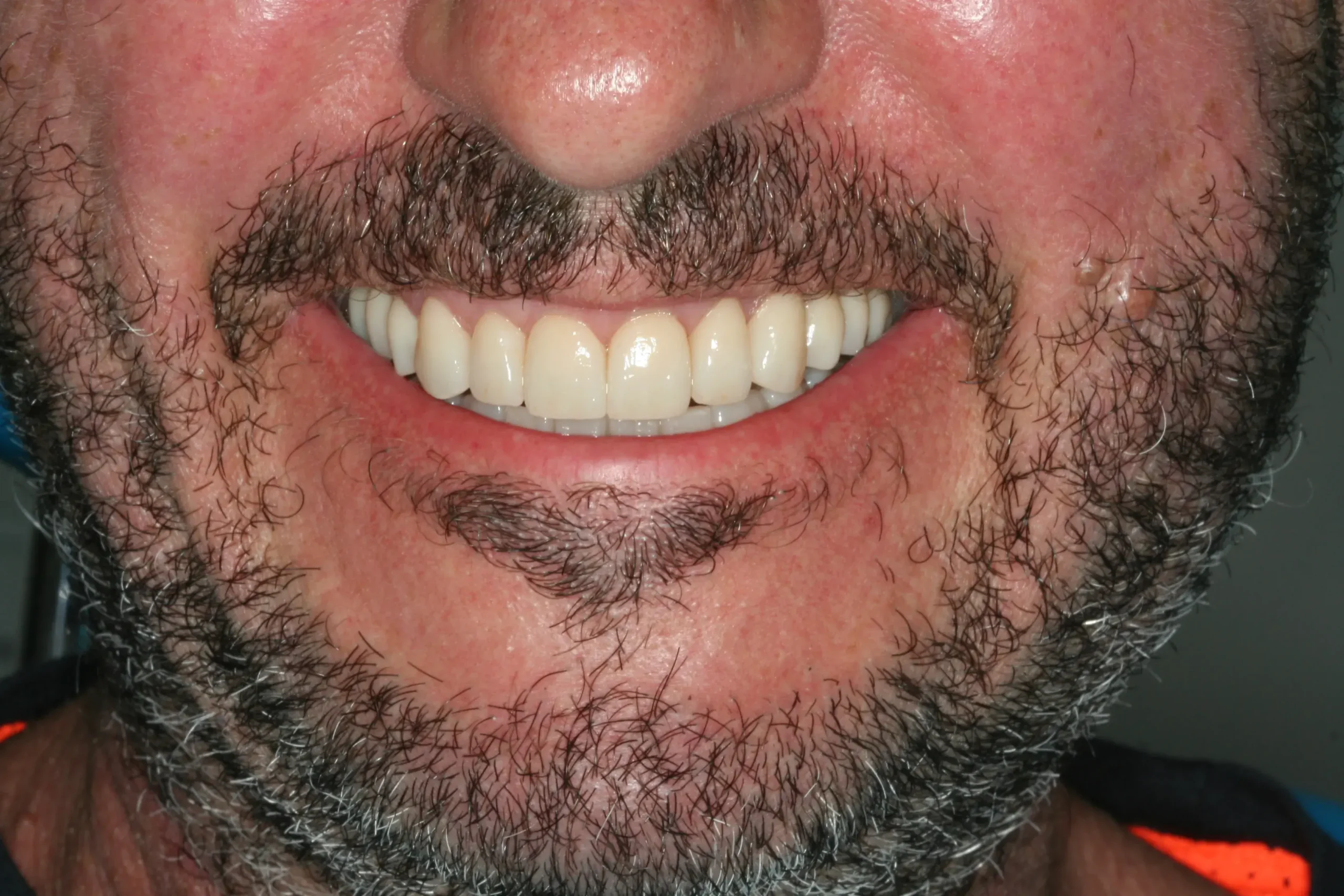 Después — Implantes y coronas CAD-CAM: rehabilitación funcional y estética
