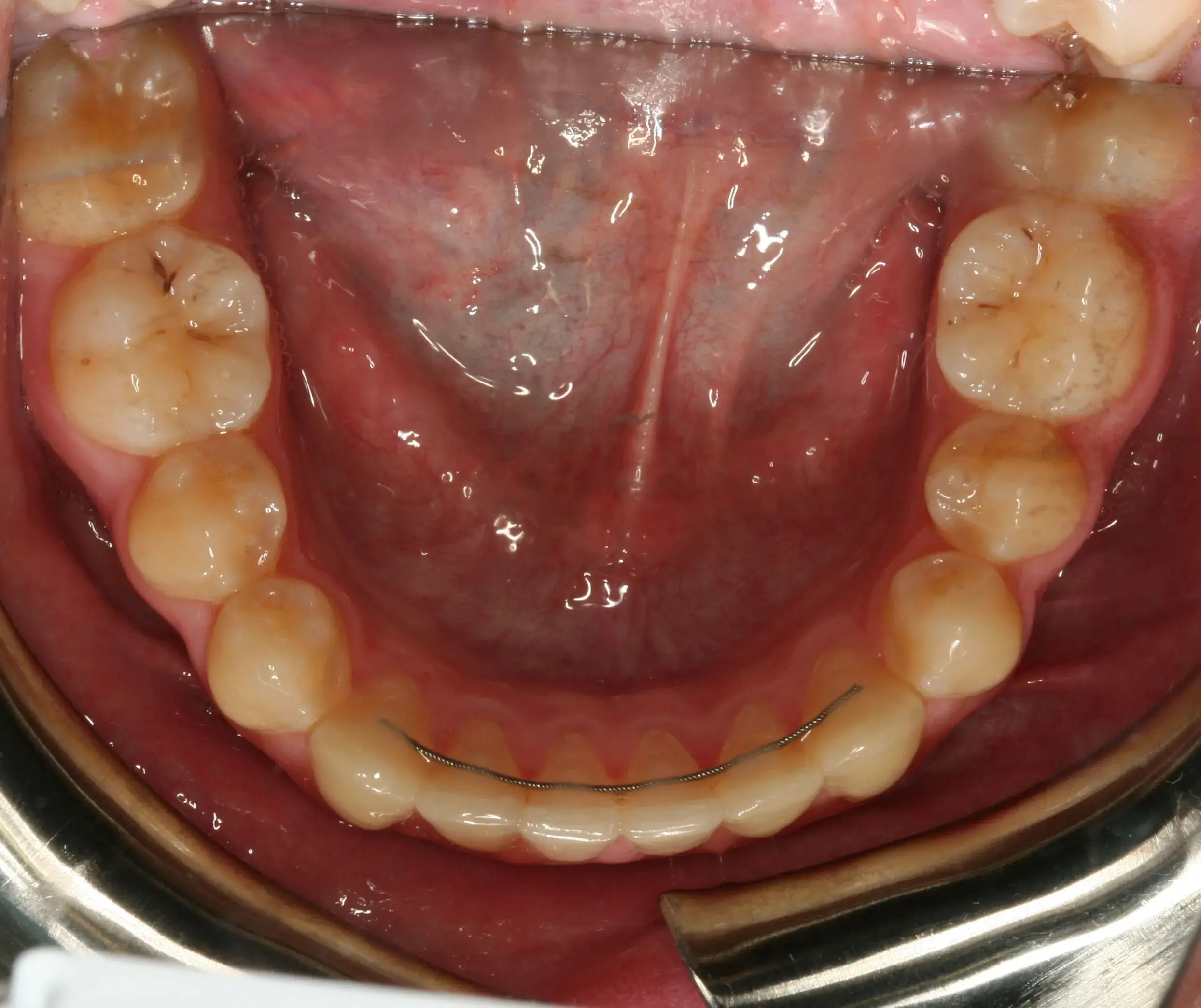 Después — Ortodoncia con brackets: molar incluido en paladar recolocado