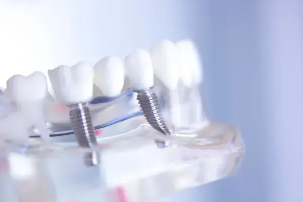 Implantes