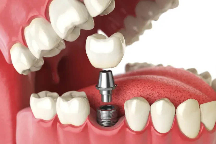 Cómo es ponerse un implante dental, paso a paso