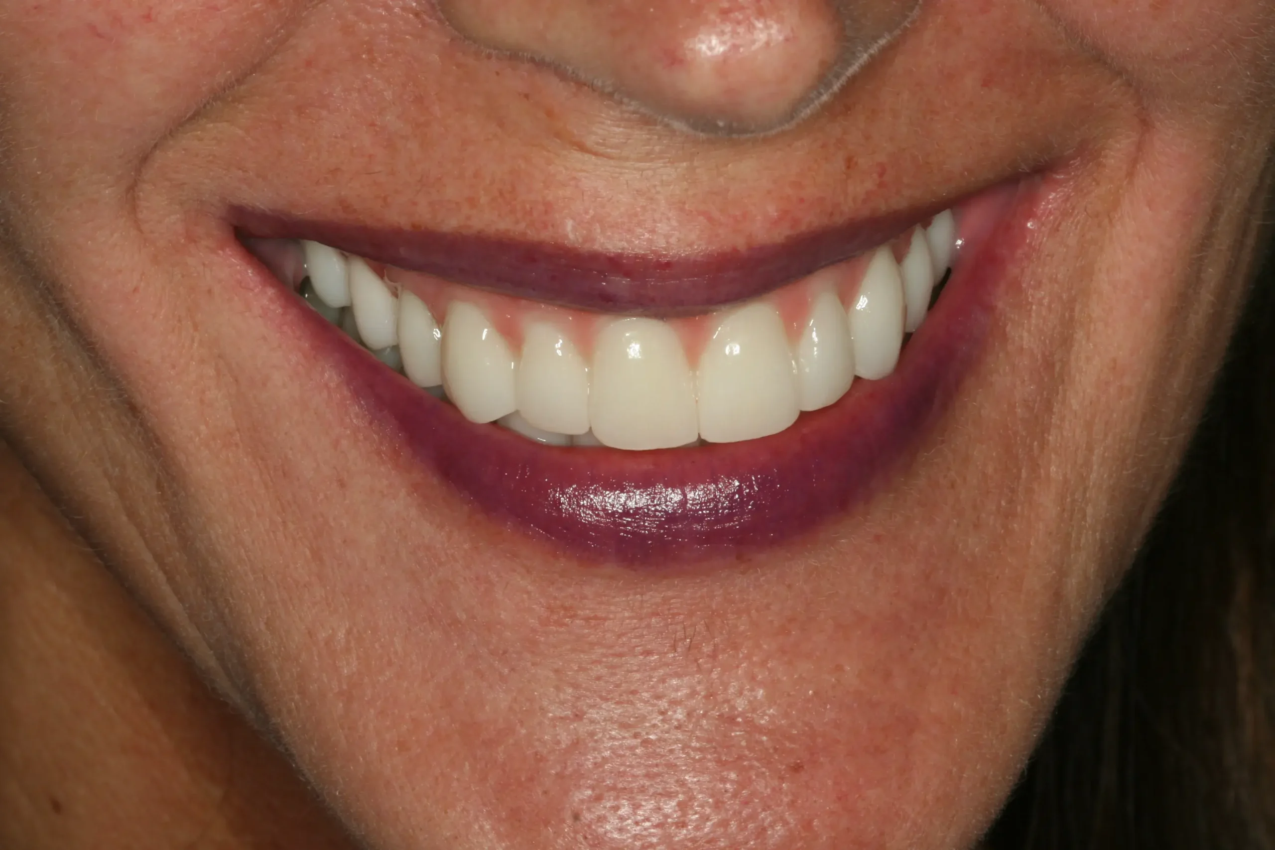 Después — Rehabilitación oral completa con 10 implantes y zirconio estratificado
