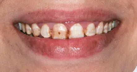 Antes — Carillas dentales de porcelana: diseño de sonrisa completo