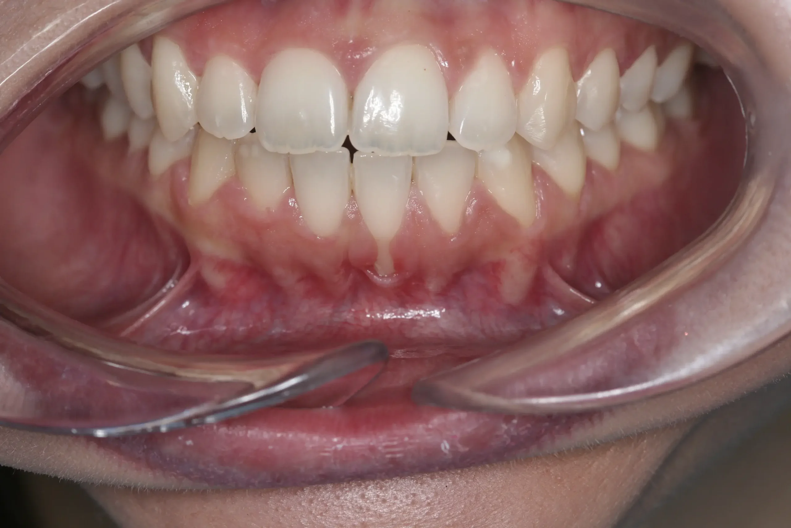 Antes — Injerto de encía para corregir recesiones gingivales