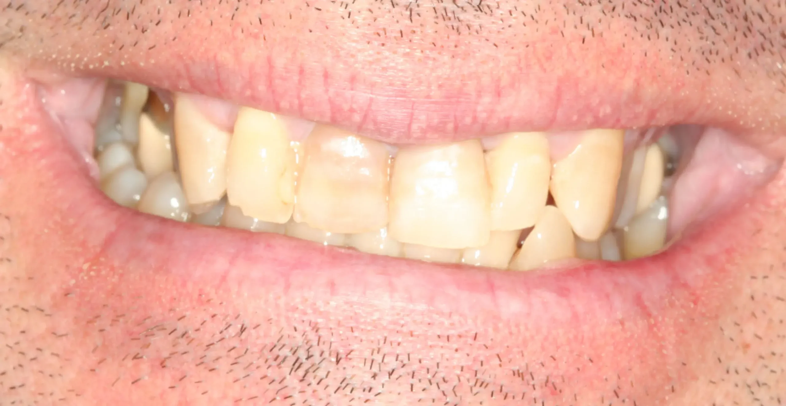 Antes — Rehabilitación completa: ortodoncia, implantes, coronas E-Max y blanqueamiento
