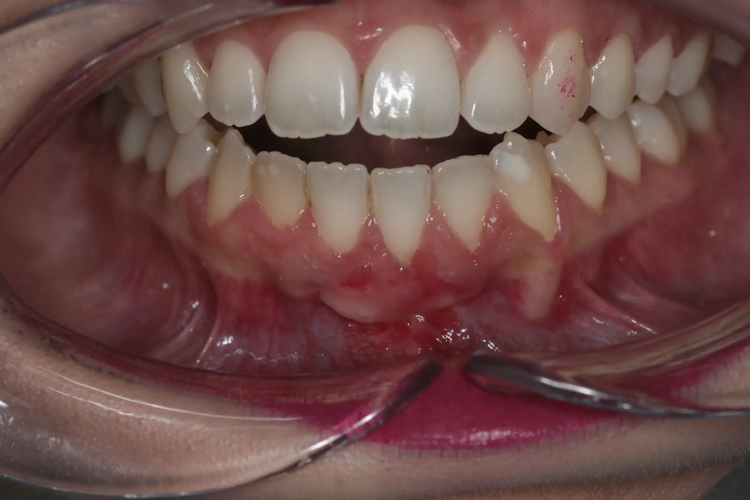 Después — Injerto de encía para corregir recesiones gingivales